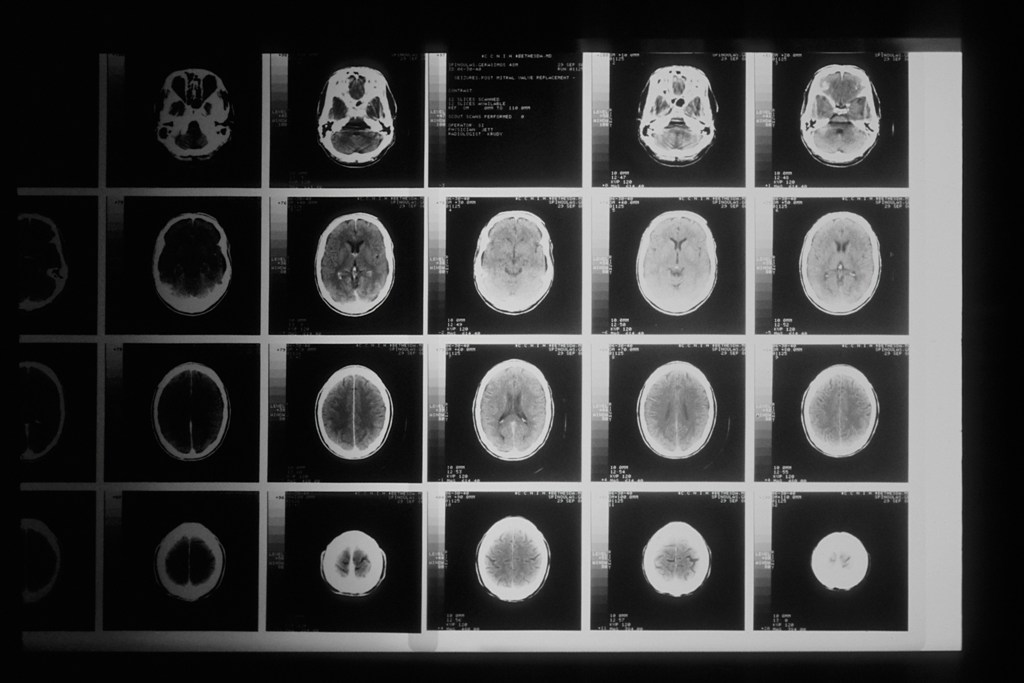 CAT scanner head X-ray.