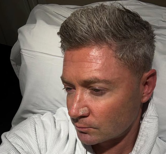 Michael Clarke, under whose leadership the national team won the 2015 World Cup, on Tuesday said he recently underwent surgery to remove skin cancer from his nose